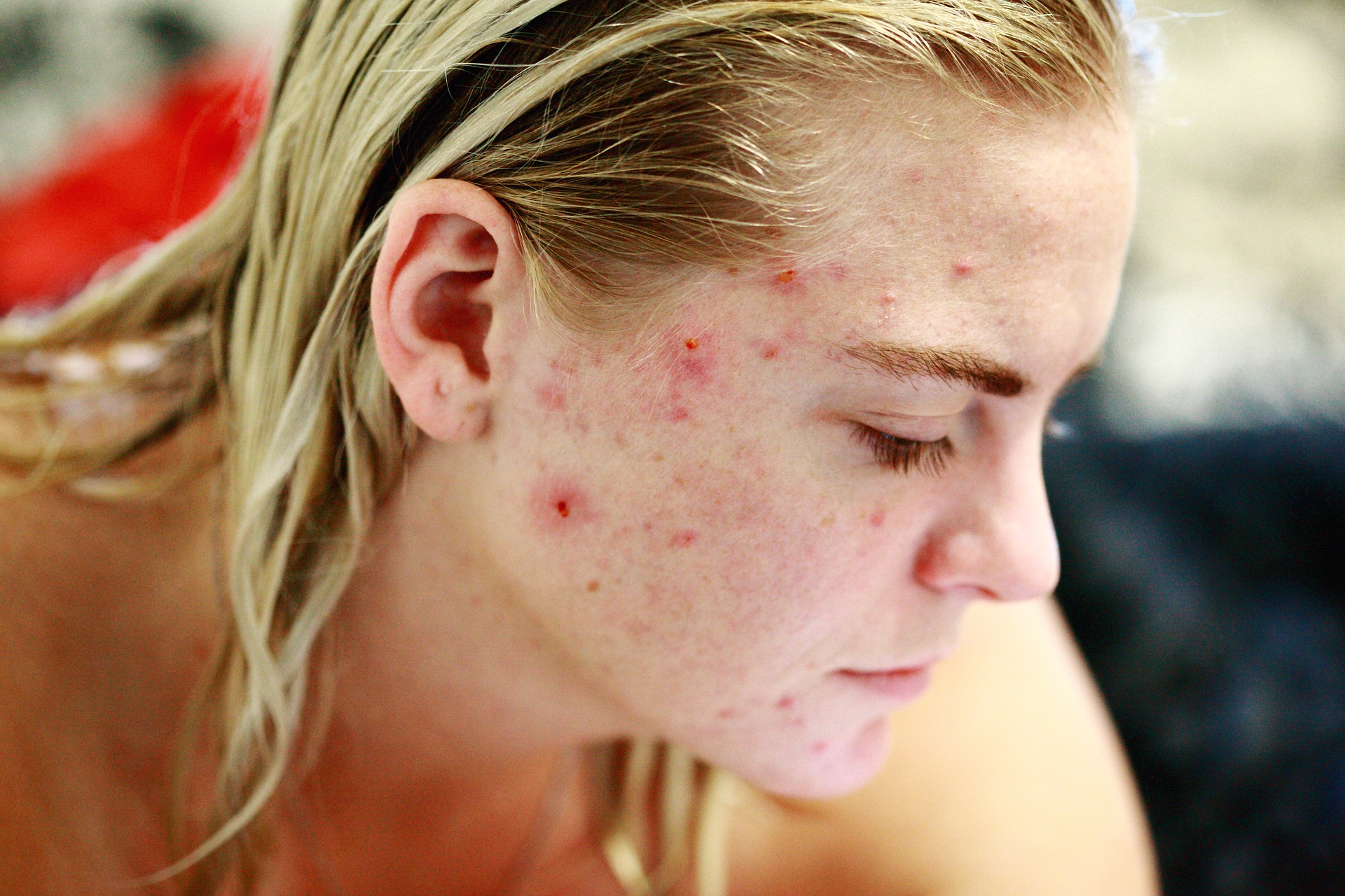 Akne Hautprobleme Darmgesundheit
